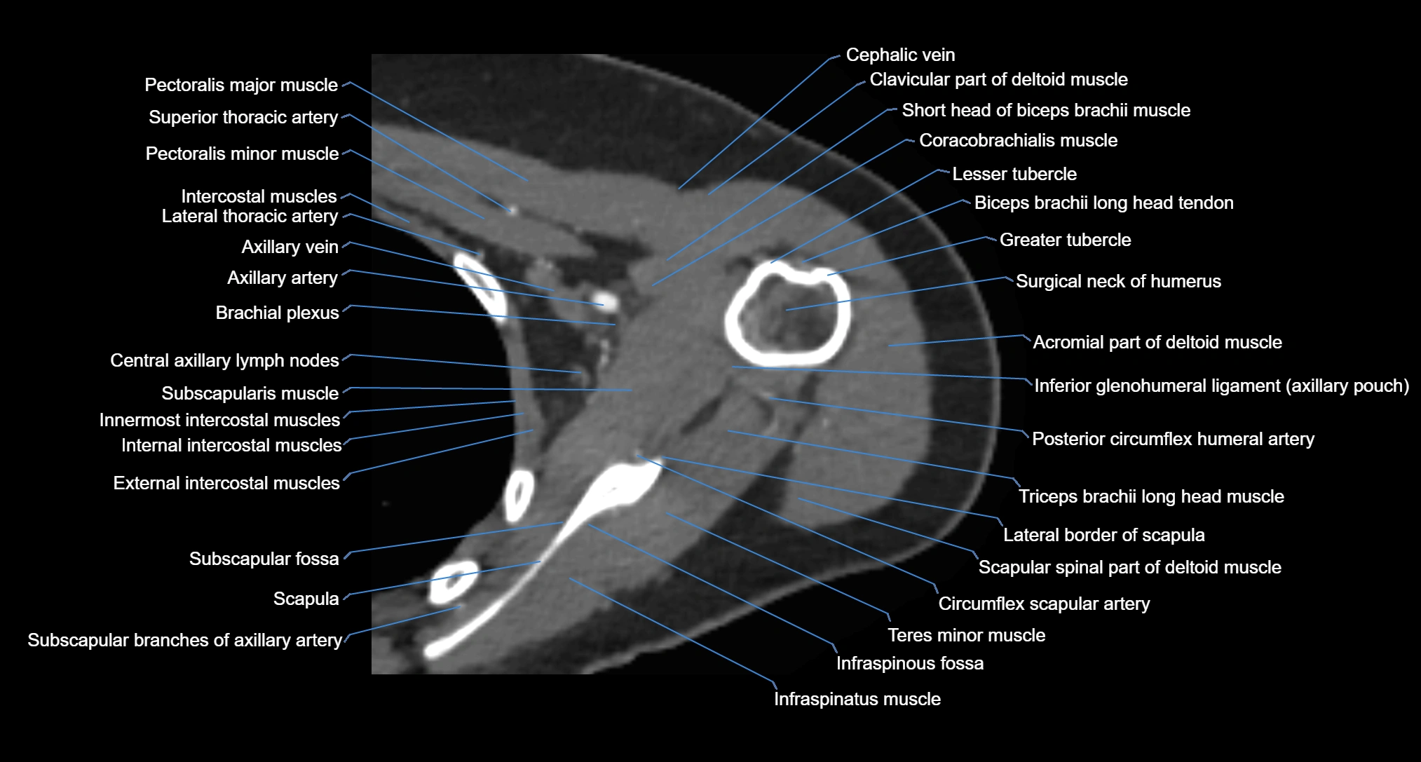 CT Shoulder axial cross sectional anatomy labelled radiology image -00043.webp